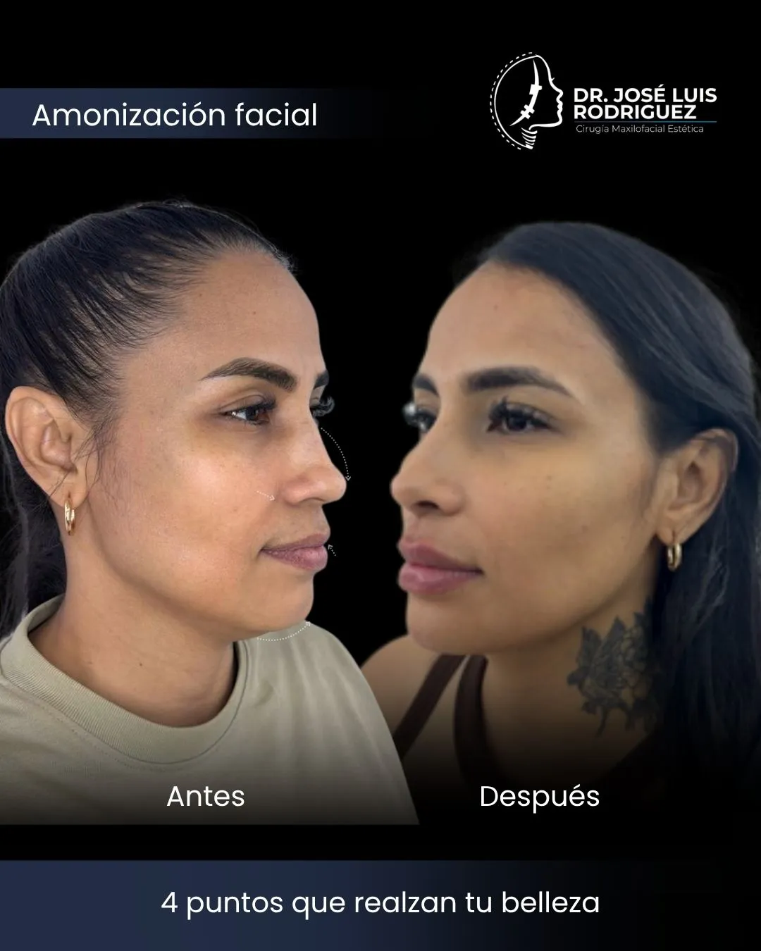 Resultado de armonización facial - Dr. José Luis Rodríguez, cirujano maxilofacial en Colombia