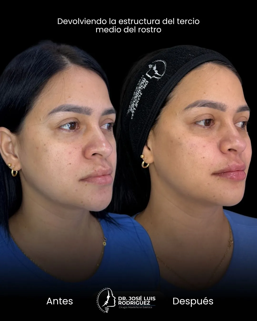 Resultado de armonización facial - Dr. José Luis Rodríguez, cirujano maxilofacial en Colombia