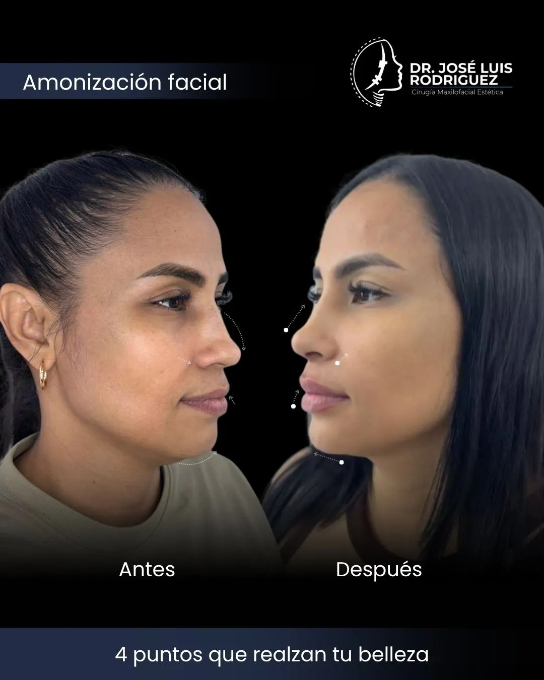 Resultado de armonización facial - Dr. José Luis Rodríguez, cirujano maxilofacial en Colombia