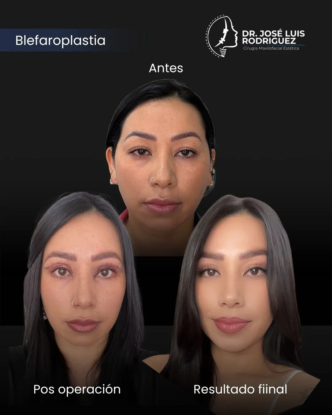 Resultado de blefaroplastia - Dr. José Luis Rodríguez, cirujano maxilofacial en Colombia