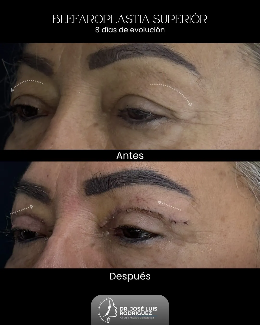 Resultado de blefaroplastia superior - Dr. José Luis Rodríguez, cirujano maxilofacial en Colombia