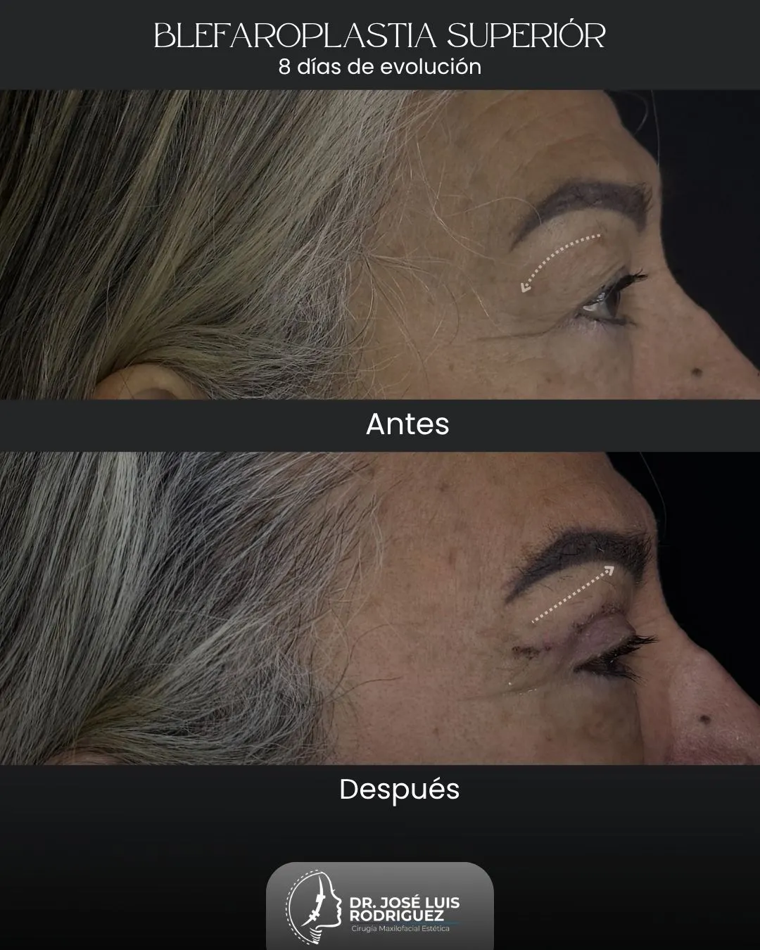Resultado de blefaroplastia por el Dr. José Luis Rodríguez
