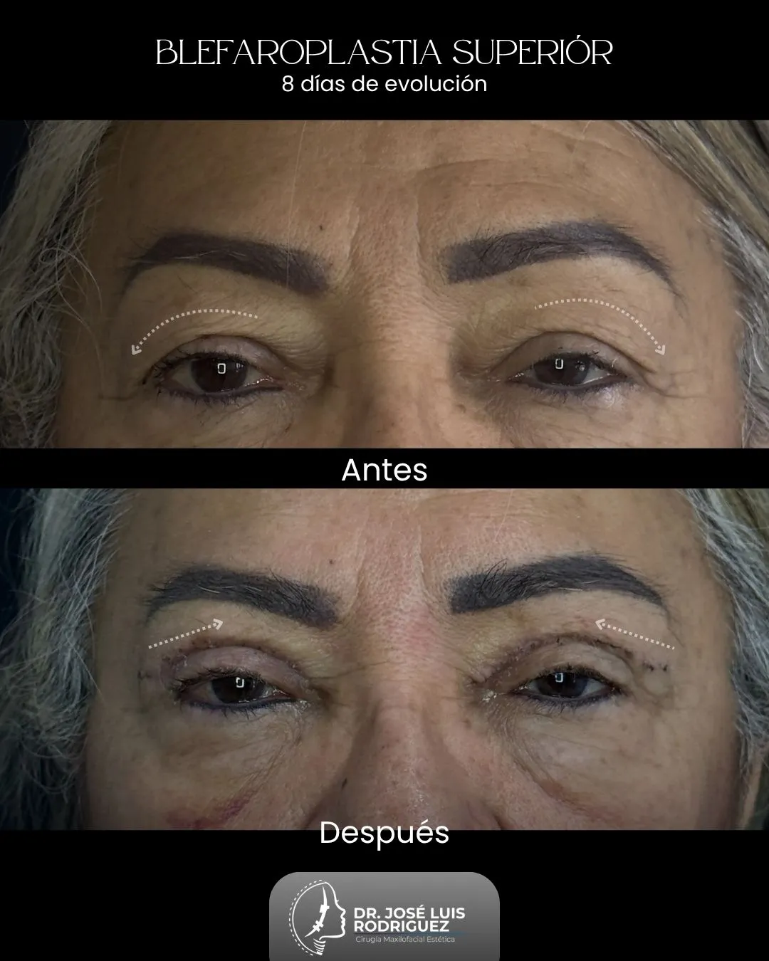 Resultado de blefaroplastia superior - Dr. José Luis Rodríguez, cirujano maxilofacial en Colombia