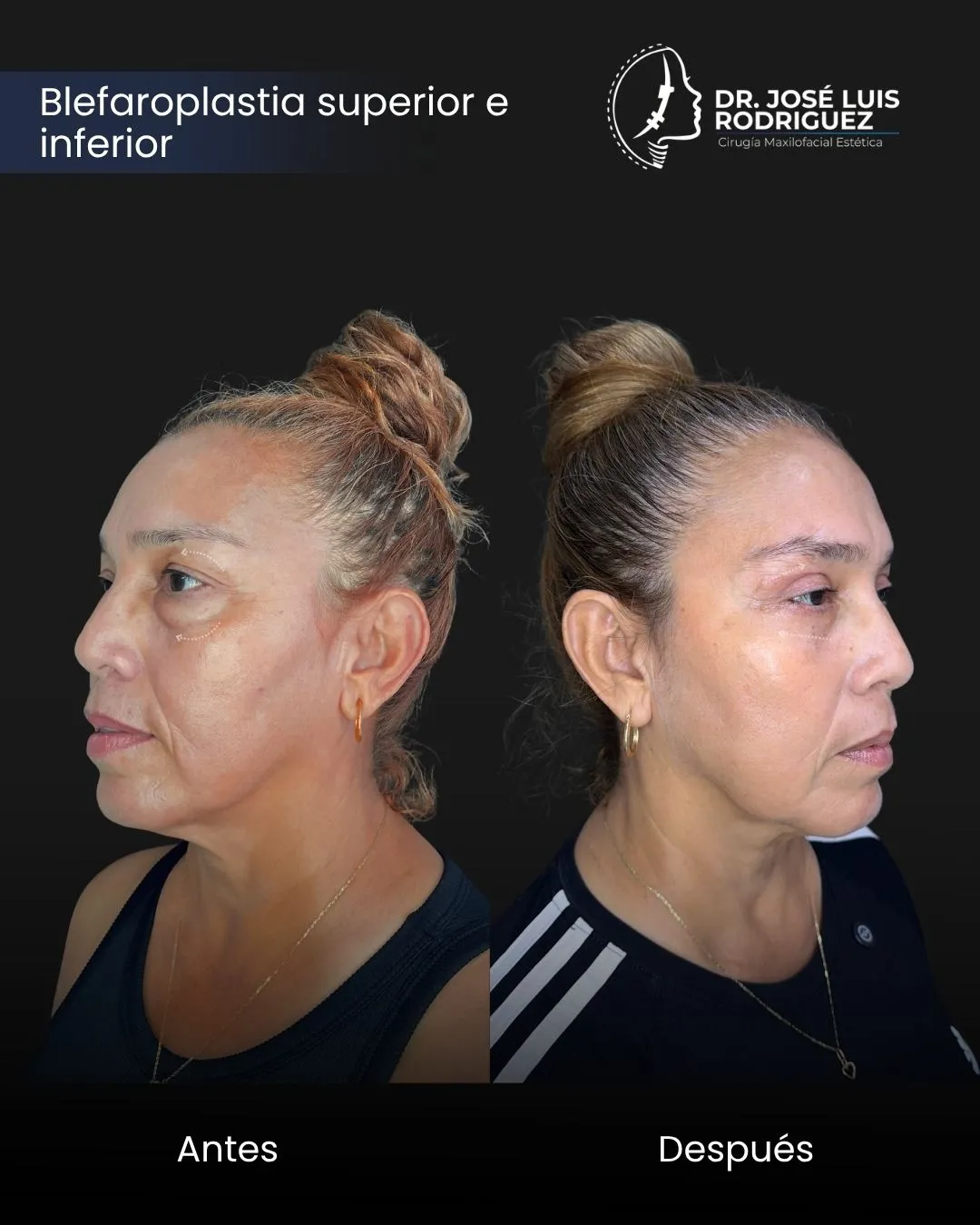 Resultado de blefaroplastia superior - Dr. José Luis Rodríguez, cirujano maxilofacial en Colombia