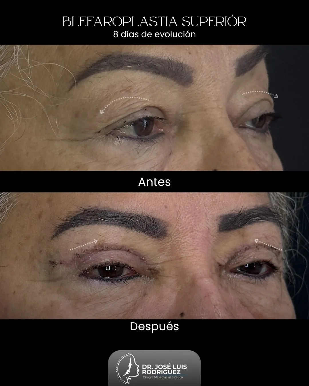 Resultado de blefaroplastia superior - Dr. José Luis Rodríguez, cirujano maxilofacial en Colombia