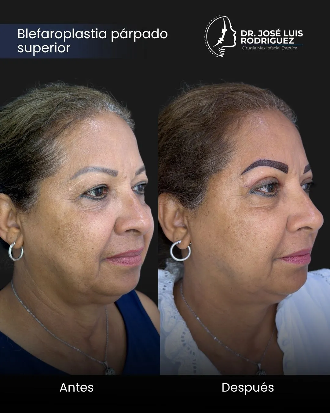 Resultado de blefaroplastia - Dr. José Luis Rodríguez, cirujano maxilofacial en Colombia