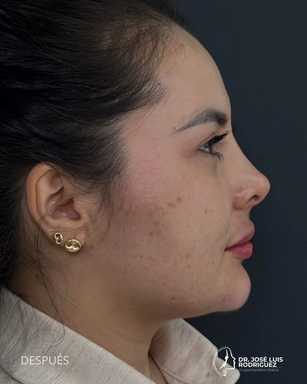 Resultado de cirugía maxilofacial - Dr. José Luis Rodríguez, cirujano maxilofacial en Colombia