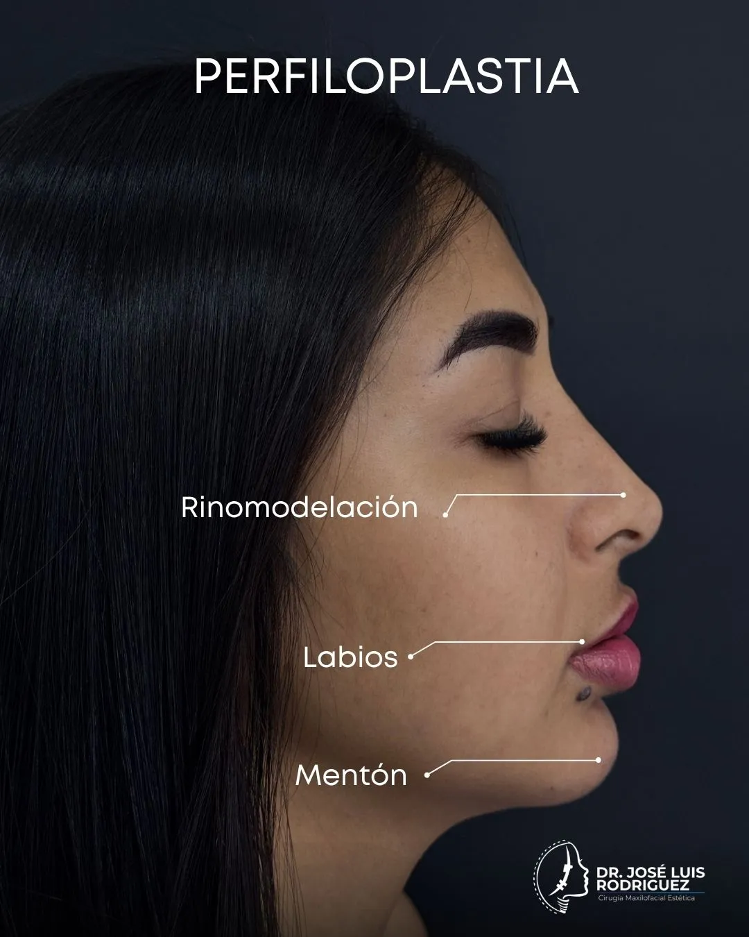Resultado de cirugía maxilofacial - Dr. José Luis Rodríguez, cirujano maxilofacial en Colombia