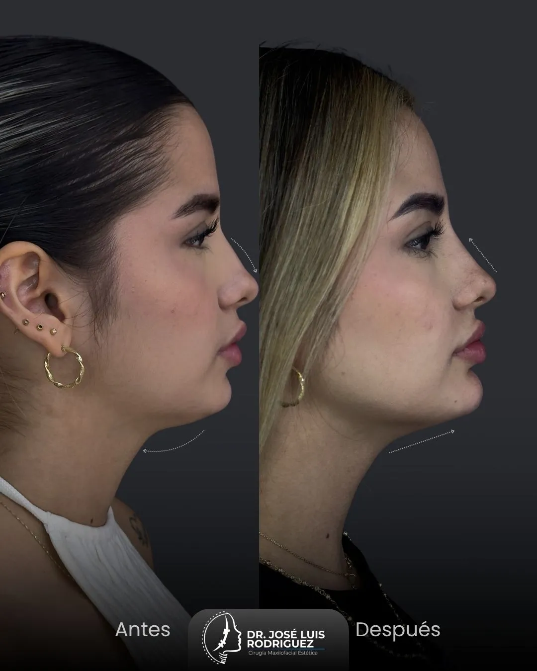 Resultado de cirugía maxilofacial - Dr. José Luis Rodríguez, cirujano maxilofacial en Colombia