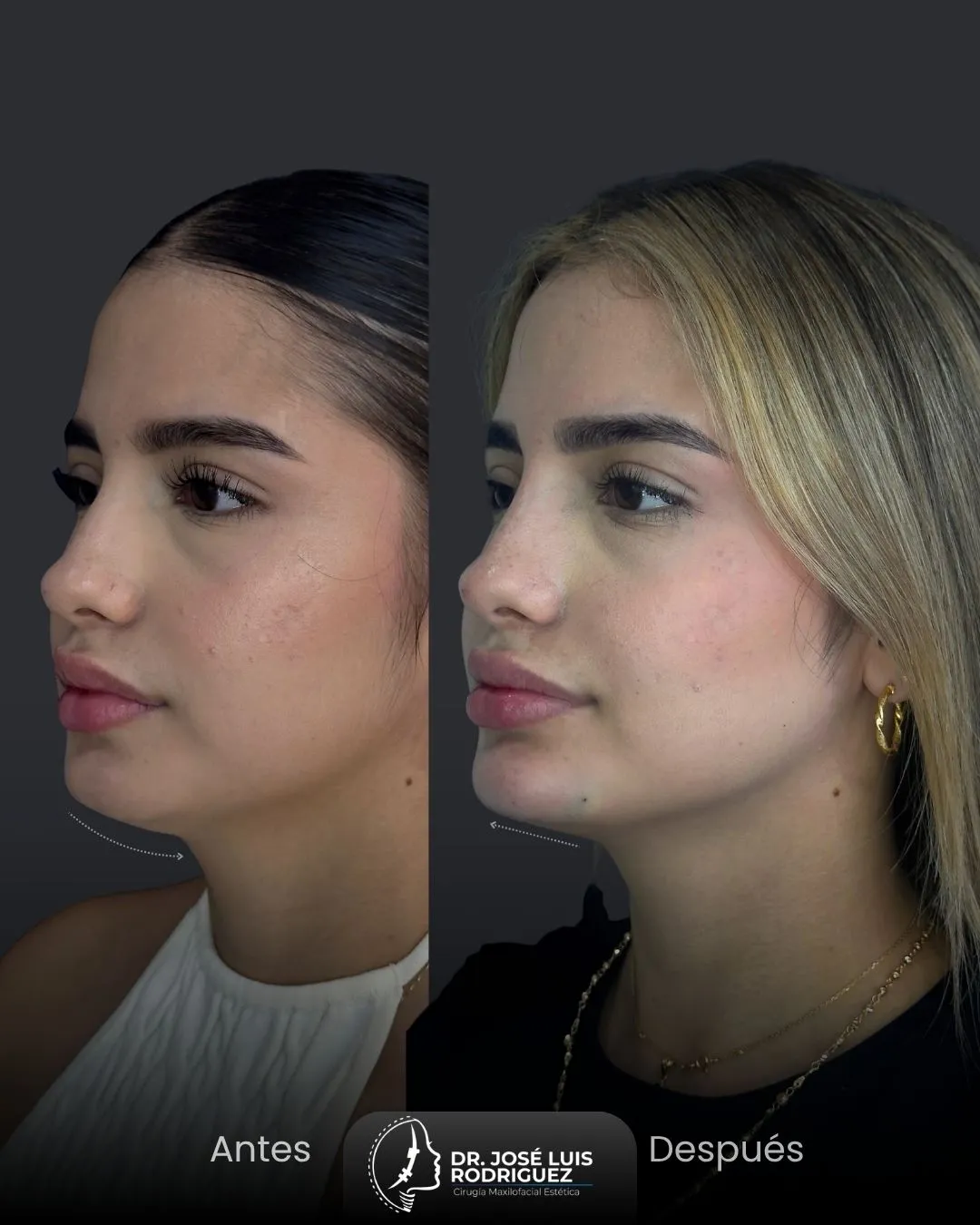 Resultado de cirugía maxilofacial - Dr. José Luis Rodríguez, cirujano maxilofacial en Colombia