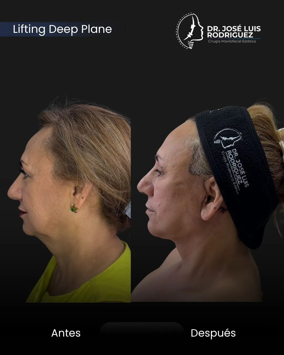 Resultado de cirugía maxilofacial - Dr. José Luis Rodríguez, cirujano maxilofacial en Colombia