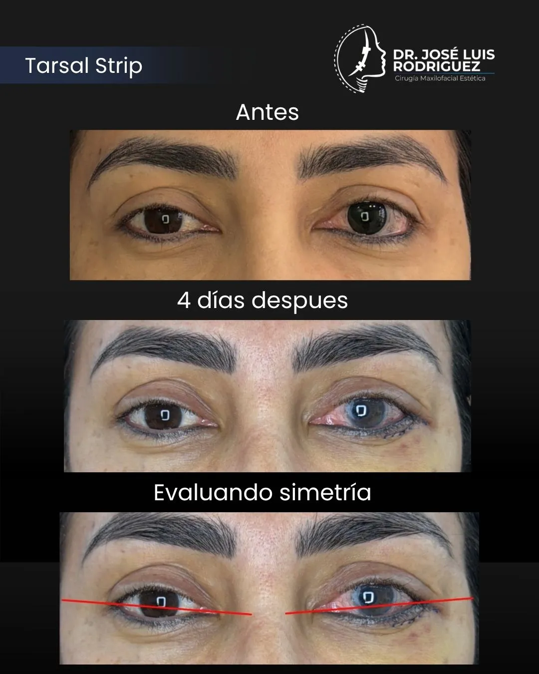 Resultado de cirugía maxilofacial - Dr. José Luis Rodríguez, cirujano maxilofacial en Colombia