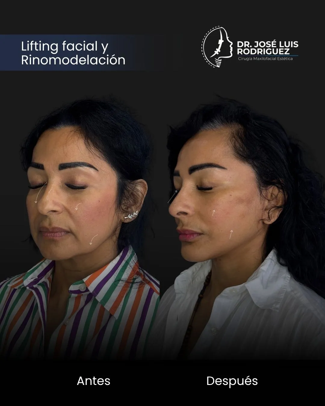 Resultado de cirugía maxilofacial - Dr. José Luis Rodríguez, cirujano maxilofacial en Colombia