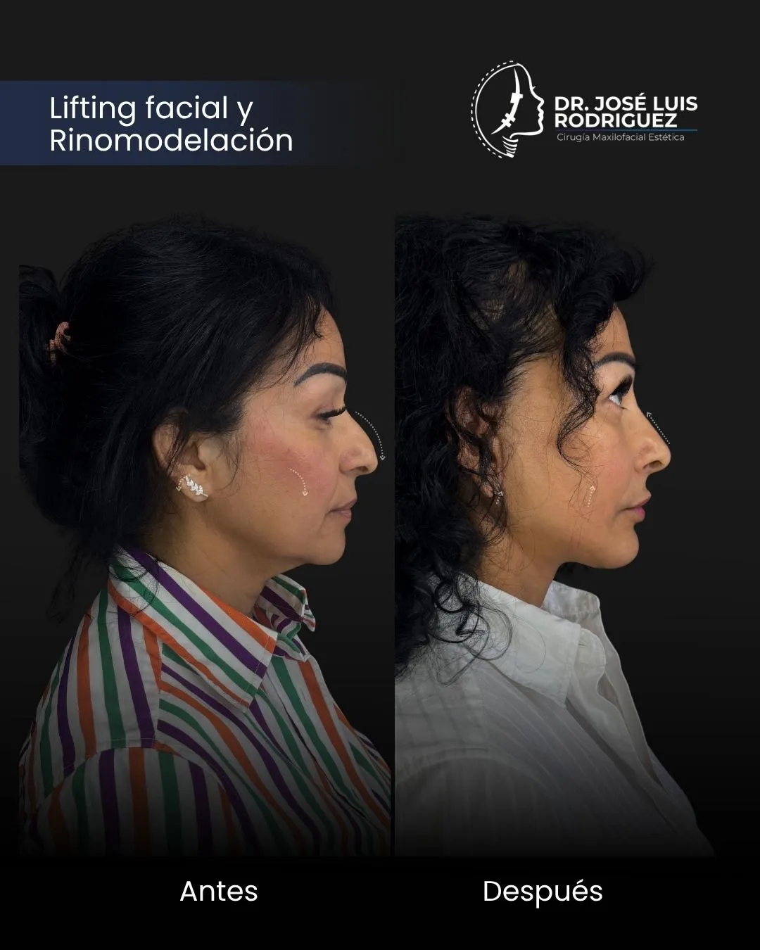 Resultado de cirugía maxilofacial - Dr. José Luis Rodríguez, cirujano maxilofacial en Colombia