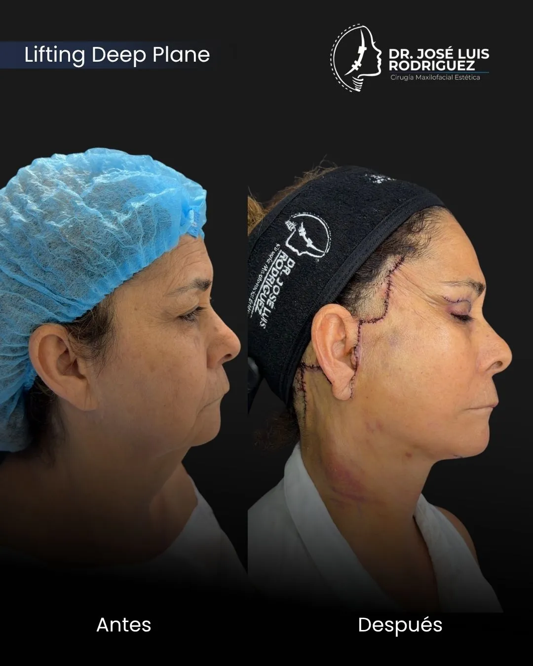 Resultado de cirugía maxilofacial - Dr. José Luis Rodríguez, cirujano maxilofacial en Colombia