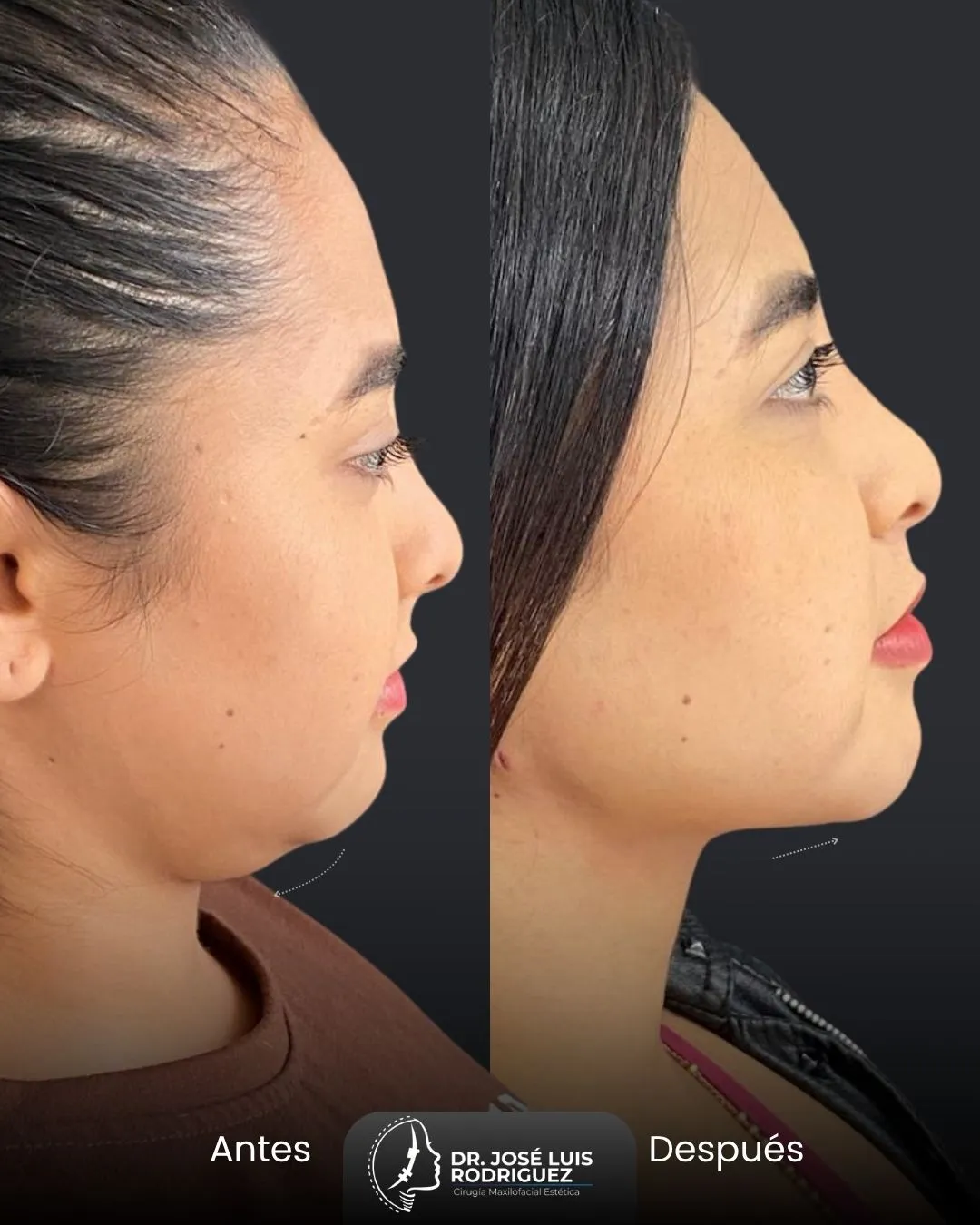 Resultado de cirugía maxilofacial - Dr. José Luis Rodríguez, cirujano maxilofacial en Colombia