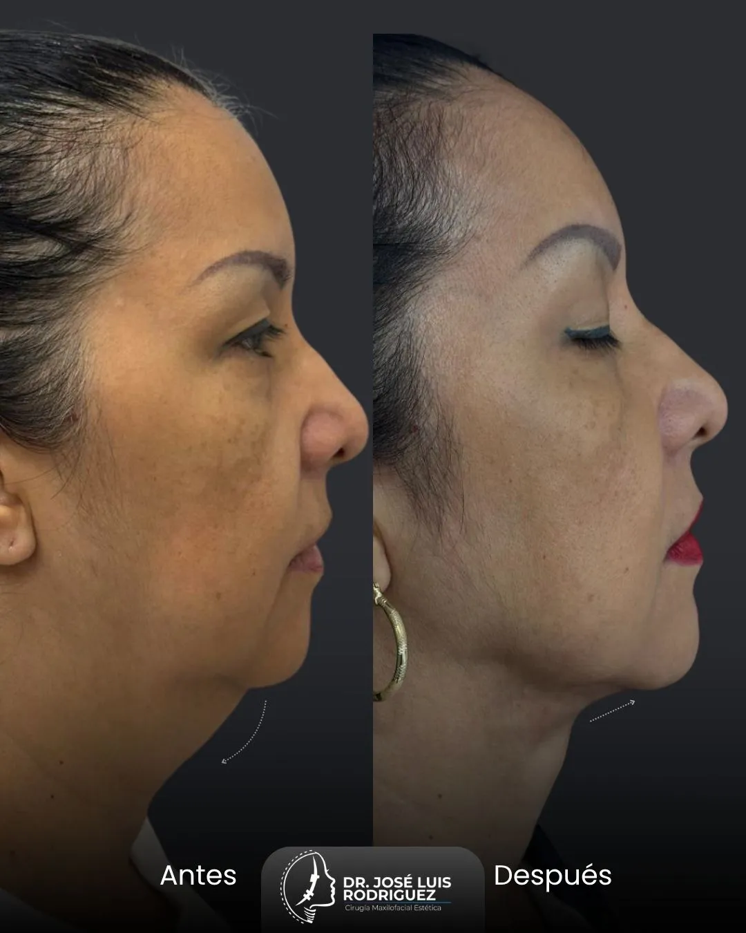 Resultado de cirugía maxilofacial - Dr. José Luis Rodríguez, cirujano maxilofacial en Colombia