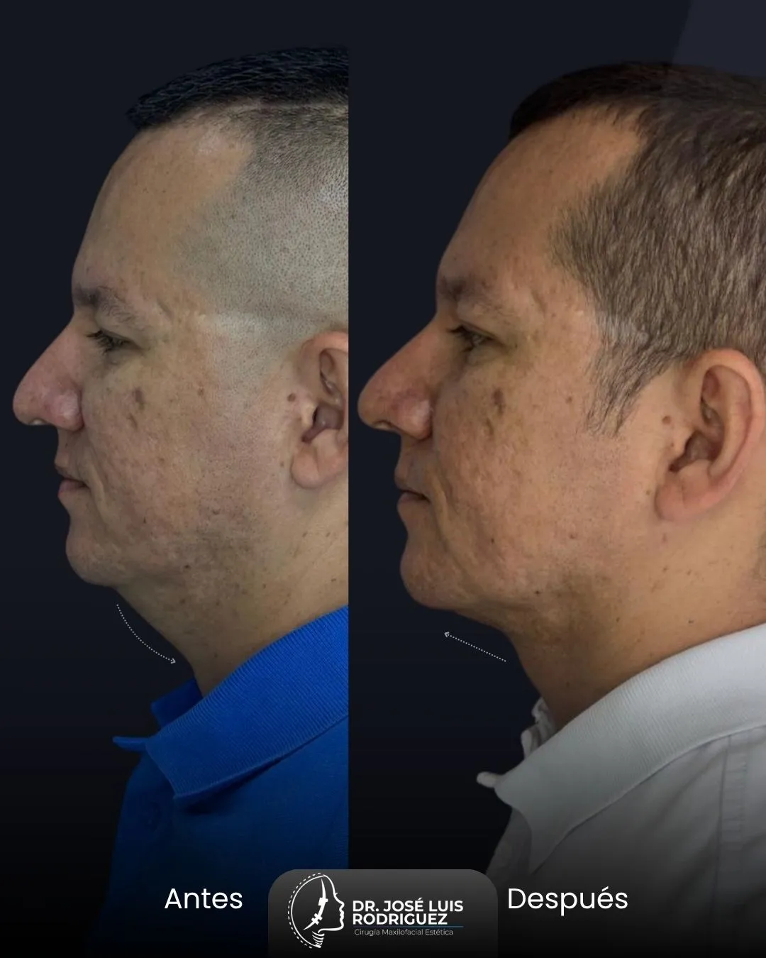 Resultado de cirugía maxilofacial - Dr. José Luis Rodríguez, cirujano maxilofacial en Colombia