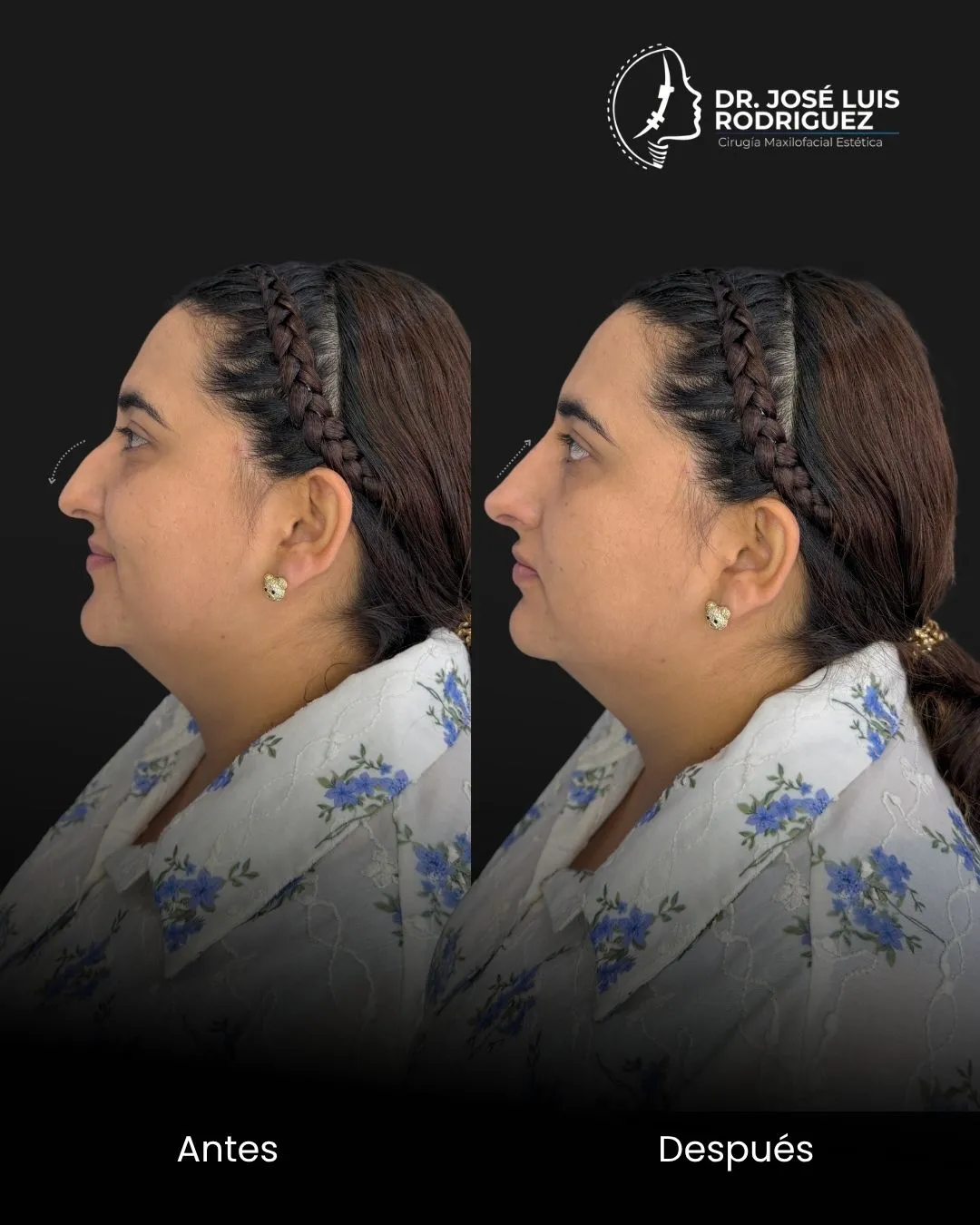 Resultado de cirugía maxilofacial - Dr. José Luis Rodríguez, cirujano maxilofacial en Colombia