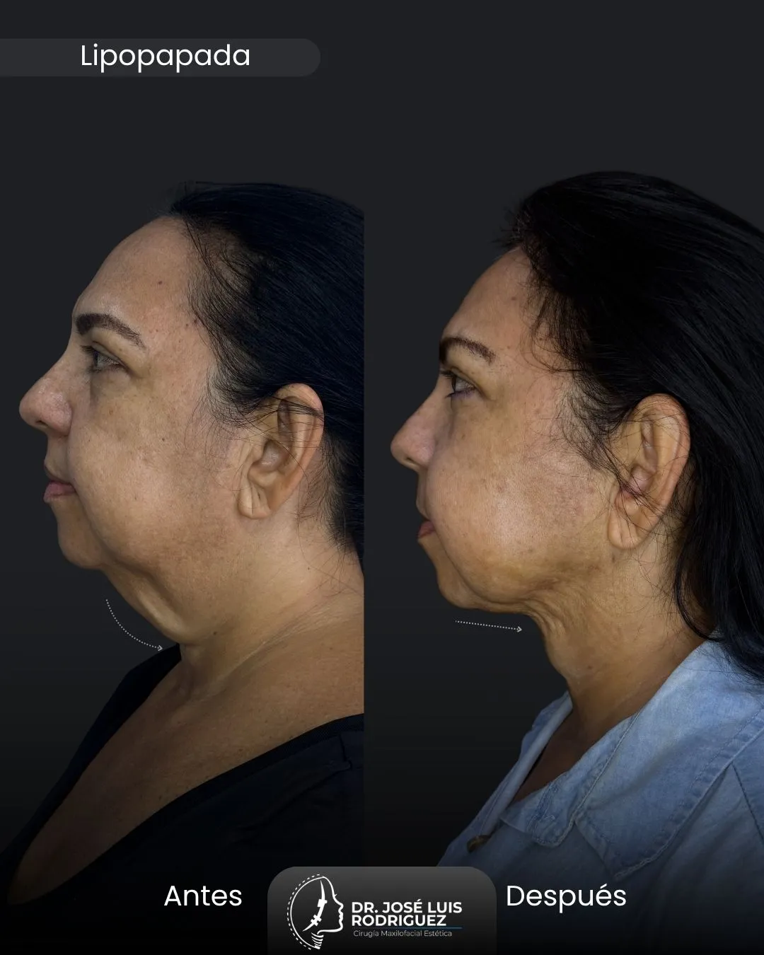 Resultado de lipopapada - Dr. José Luis Rodríguez, cirujano maxilofacial en Colombia