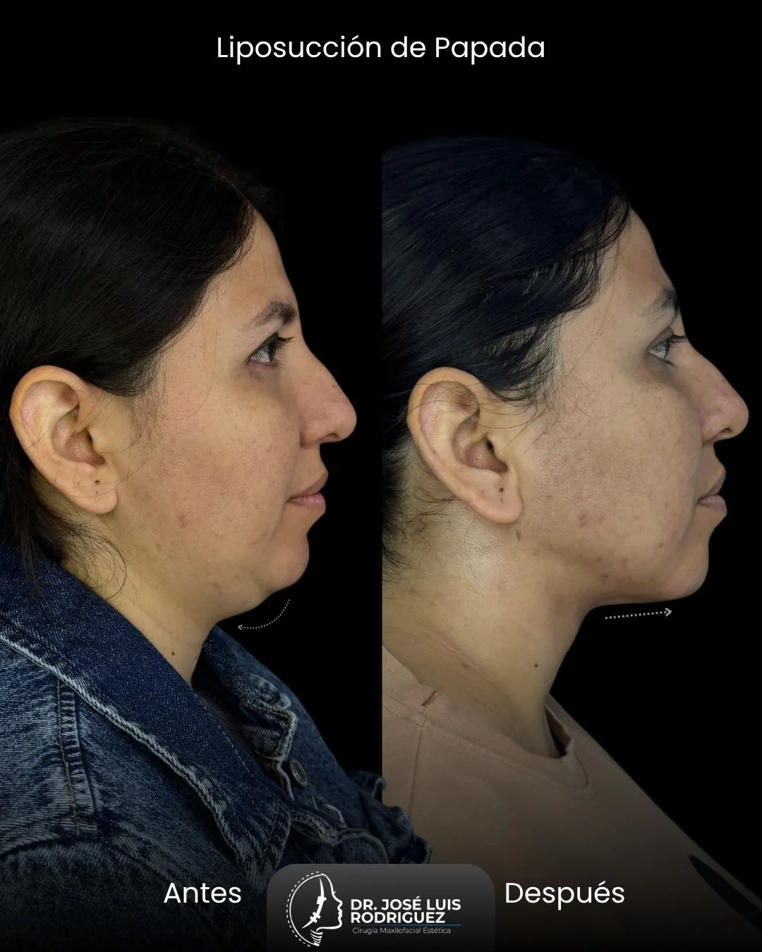 Resultado de liposucción de papada - Dr. José Luis Rodríguez, cirujano maxilofacial en Colombia