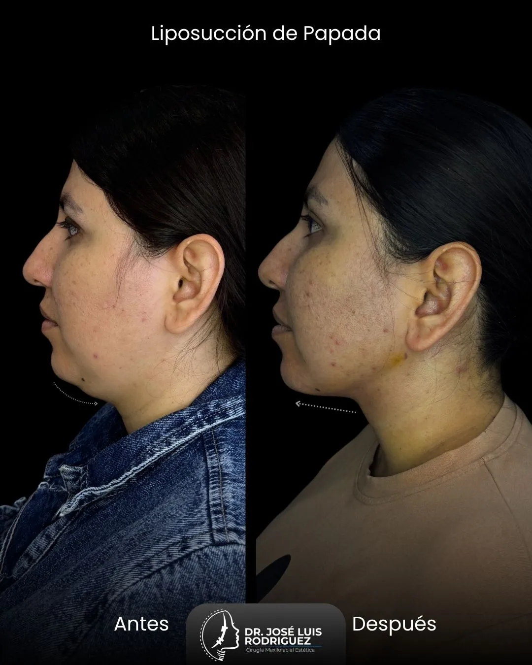 Resultado de liposucción de papada - Dr. José Luis Rodríguez, cirujano maxilofacial en Colombia
