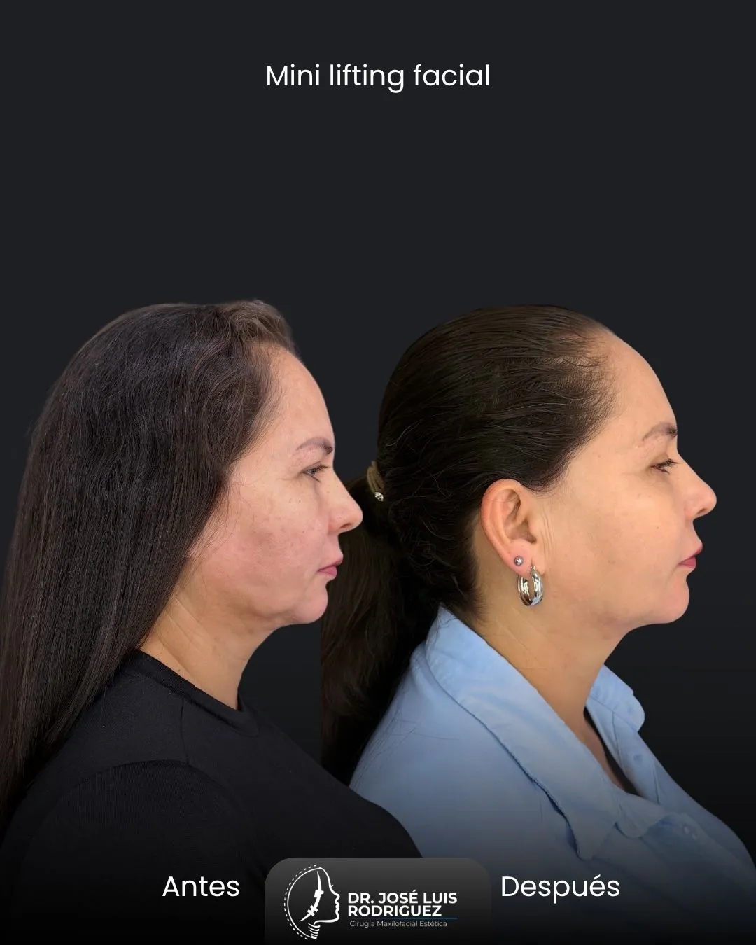 Resultado de mini lifting facial por el Dr. José Luis Rodríguez