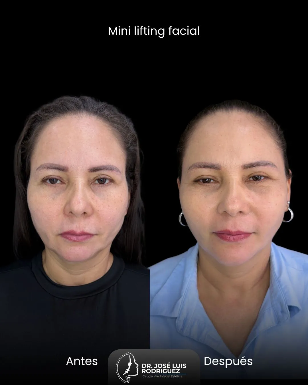 Resultado de mini lifting facial - Dr. José Luis Rodríguez, cirujano maxilofacial en Colombia