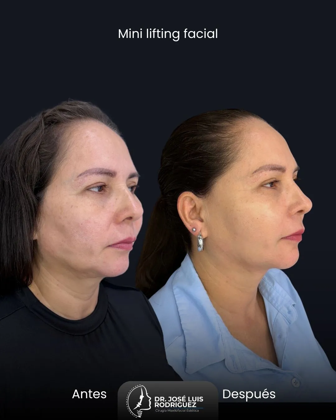Resultado de mini lifting facial - Dr. José Luis Rodríguez, cirujano maxilofacial en Colombia