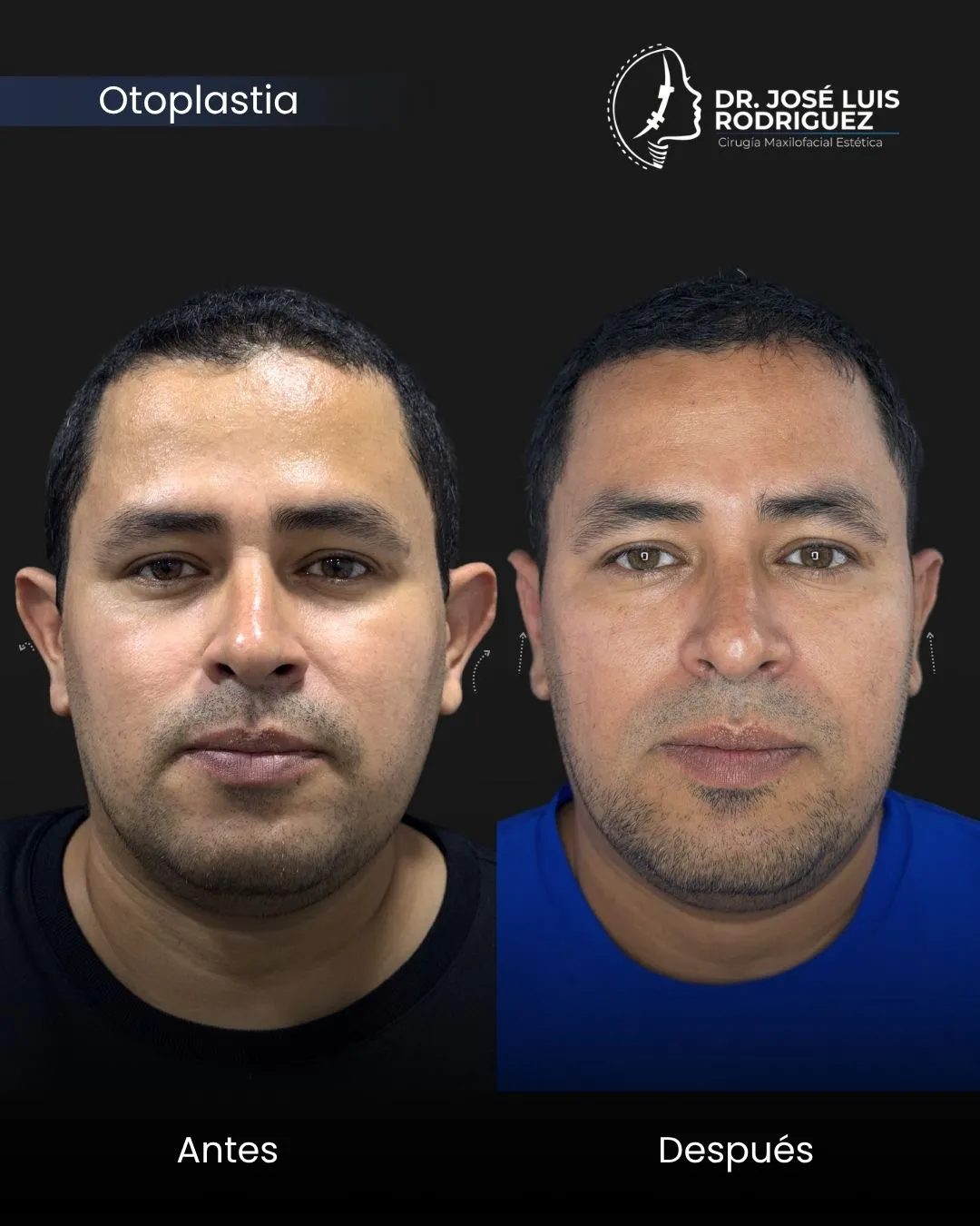 Resultado de otoplastia - Dr. José Luis Rodríguez, cirujano maxilofacial en Colombia