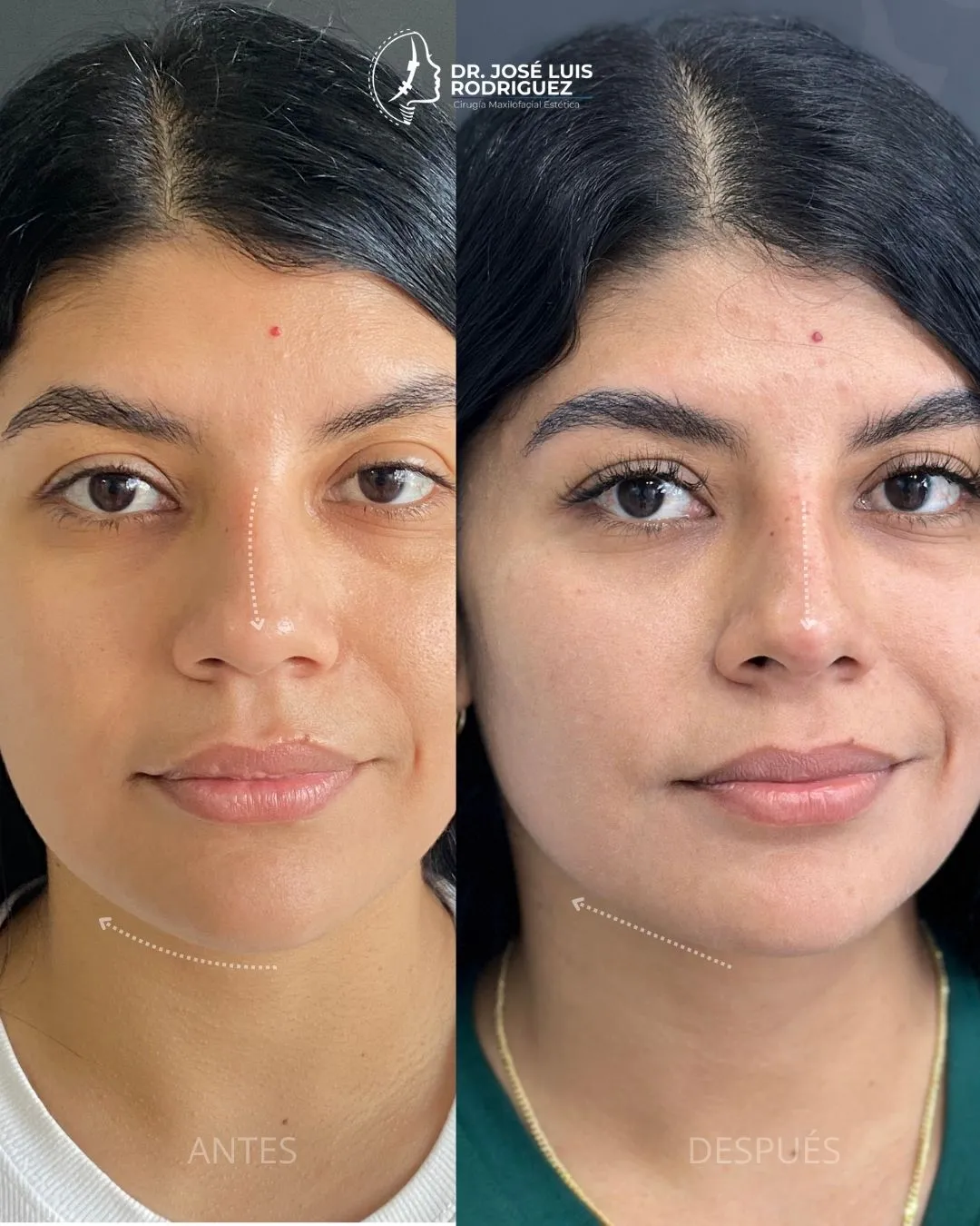 Resultado de perfiloplastia - Dr. José Luis Rodríguez, cirujano maxilofacial en Colombia