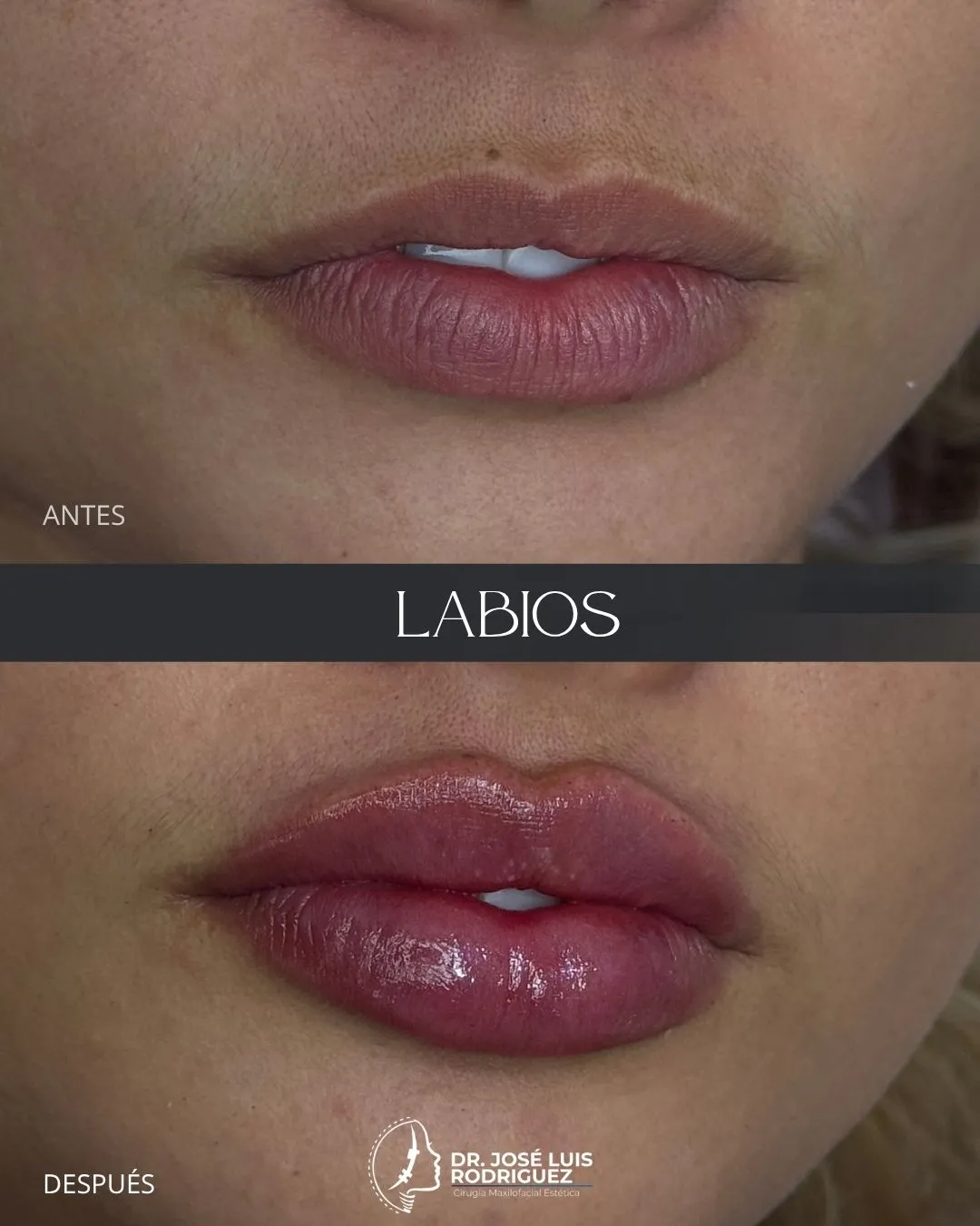 Resultado de perfiloplastia - Dr. José Luis Rodríguez, cirujano maxilofacial en Colombia