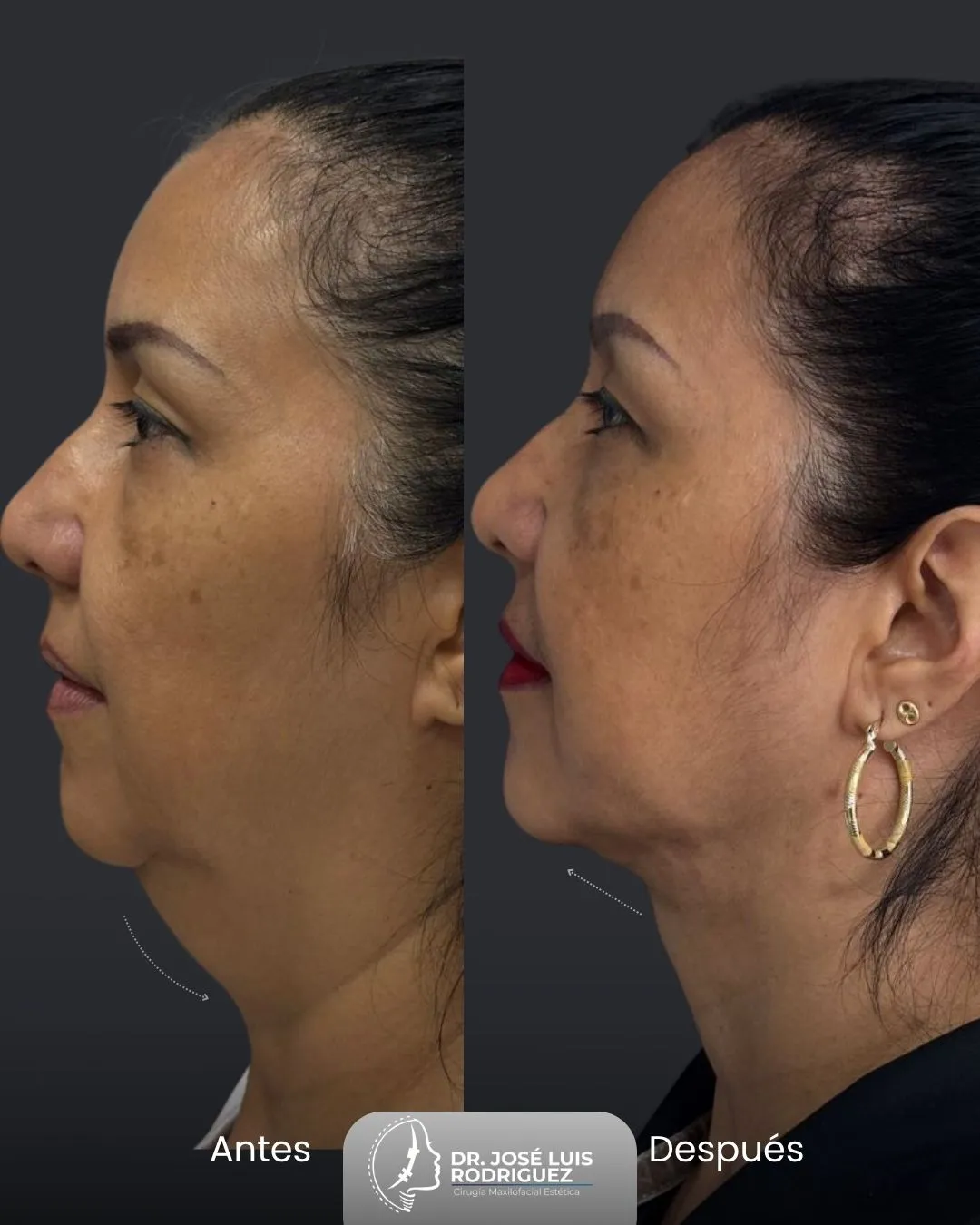 Resultado de perfiloplastia - Dr. José Luis Rodríguez, cirujano maxilofacial en Colombia