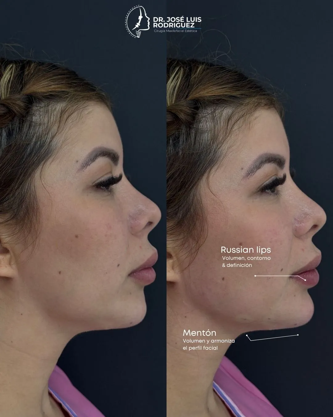 Resultado de perfiloplastia - Dr. José Luis Rodríguez, cirujano maxilofacial en Colombia