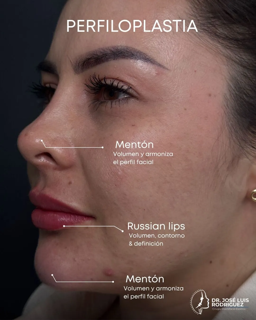 Resultado de perfiloplastia por el Dr. José Luis Rodríguez