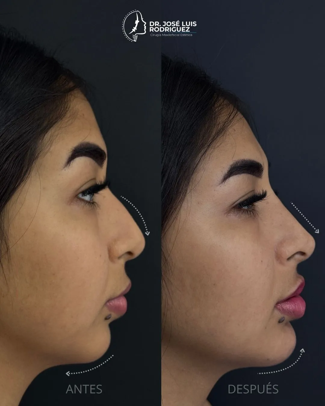 Resultado de perfiloplastia - Dr. José Luis Rodríguez, cirujano maxilofacial en Colombia