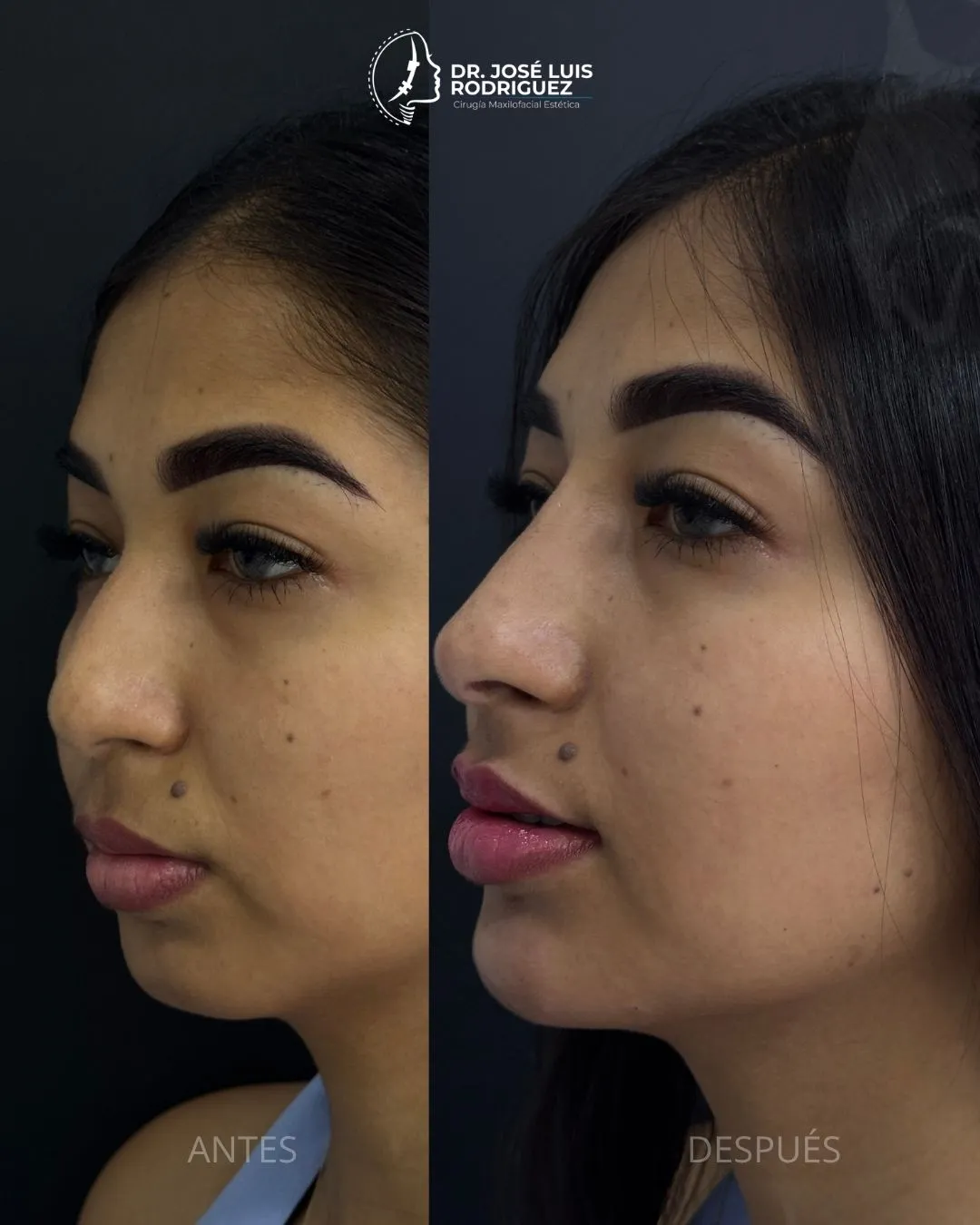Resultado de perfiloplastia - Dr. José Luis Rodríguez, cirujano maxilofacial en Colombia