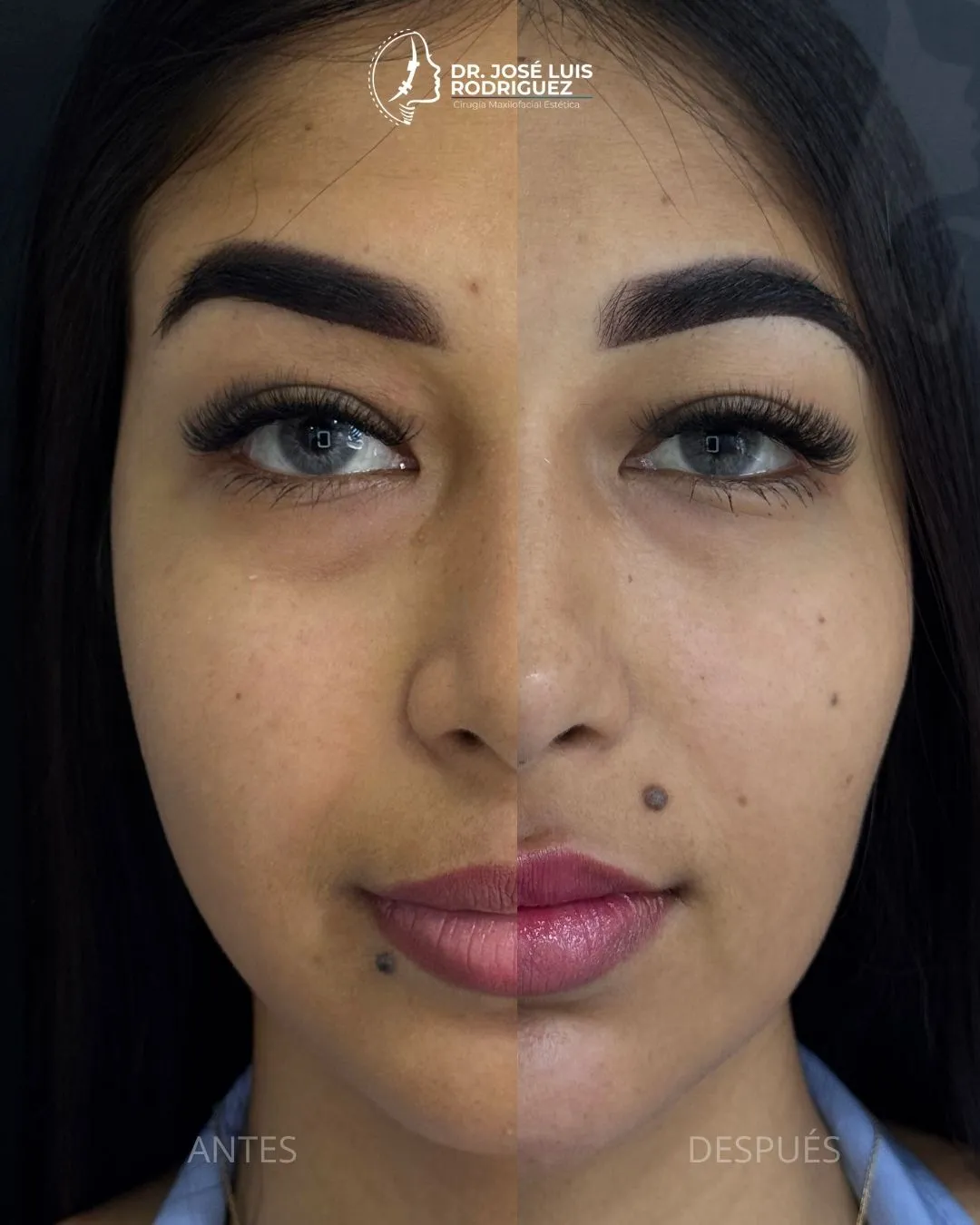 Resultado de perfiloplastia - Dr. José Luis Rodríguez, cirujano maxilofacial en Colombia