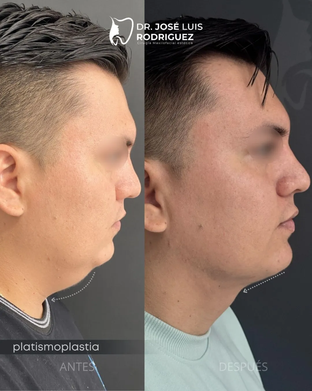 Resultado de perfiloplastia - Dr. José Luis Rodríguez, cirujano maxilofacial en Colombia