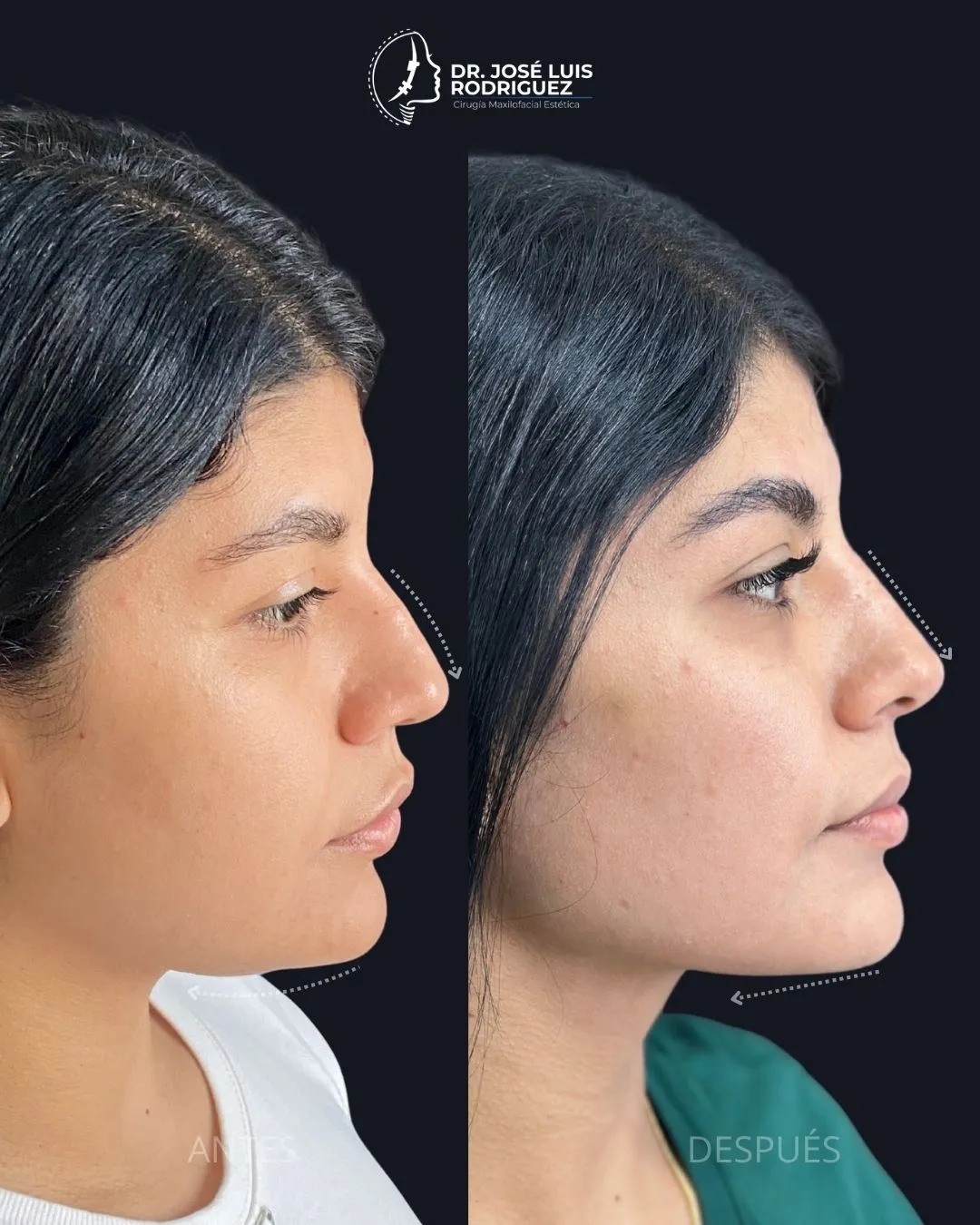 Resultado de perfiloplastia - Dr. José Luis Rodríguez, cirujano maxilofacial en Colombia