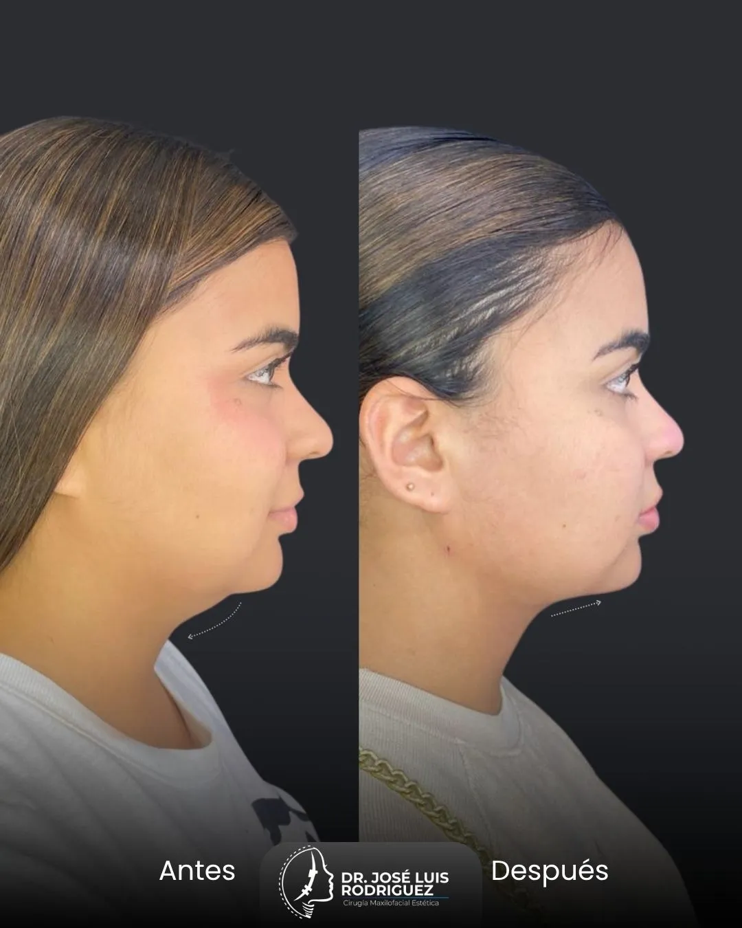 Resultado de perfiloplastia - Dr. José Luis Rodríguez, cirujano maxilofacial en Colombia