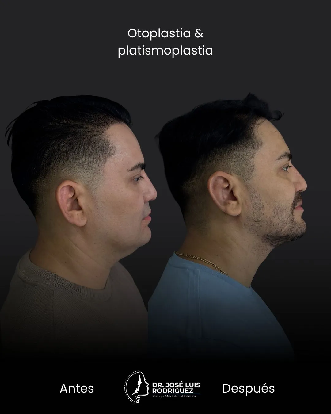 Resultado de platismoplastia - Dr. José Luis Rodríguez, cirujano maxilofacial en Colombia