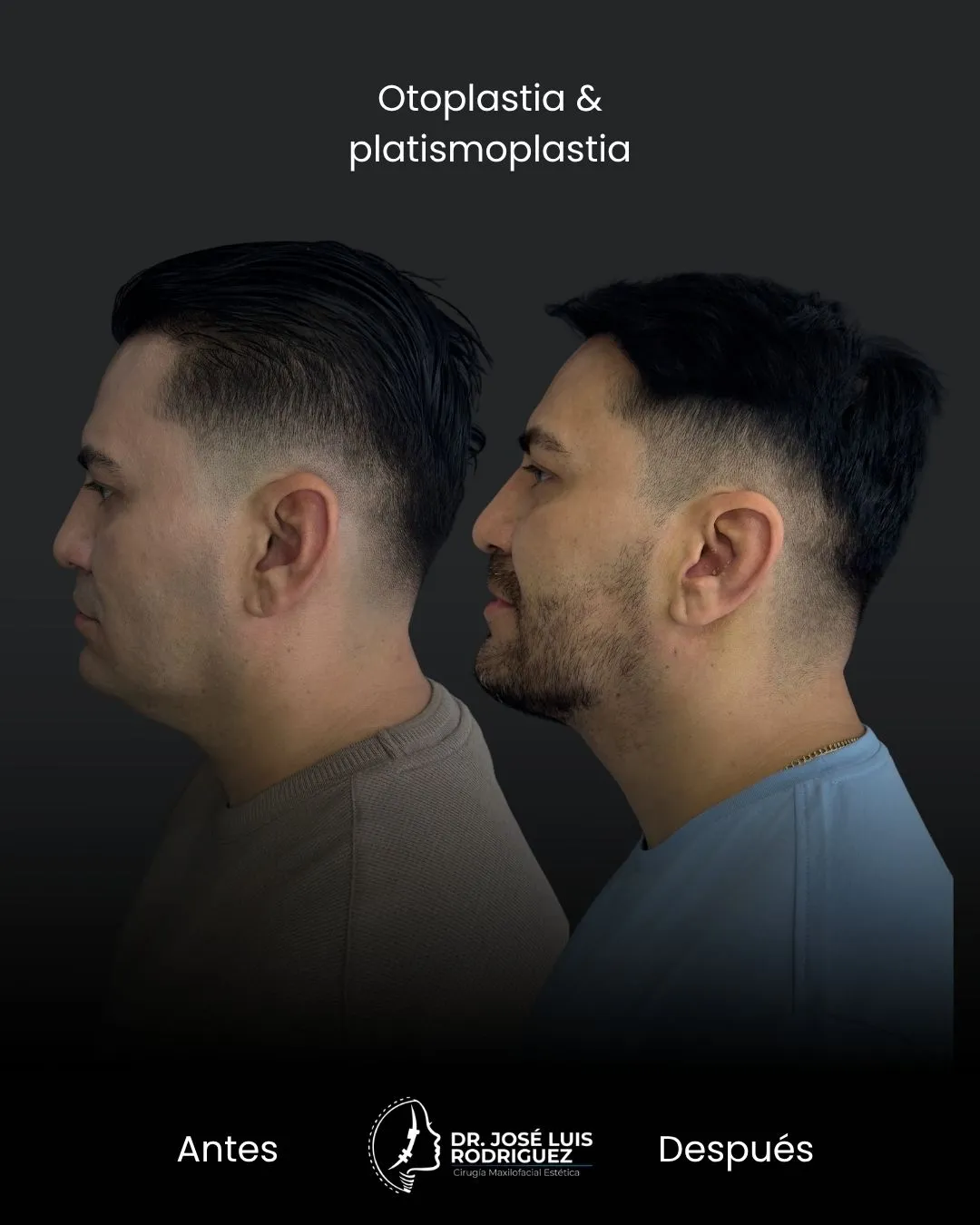 Resultado de platismoplastia - Dr. José Luis Rodríguez, cirujano maxilofacial en Colombia