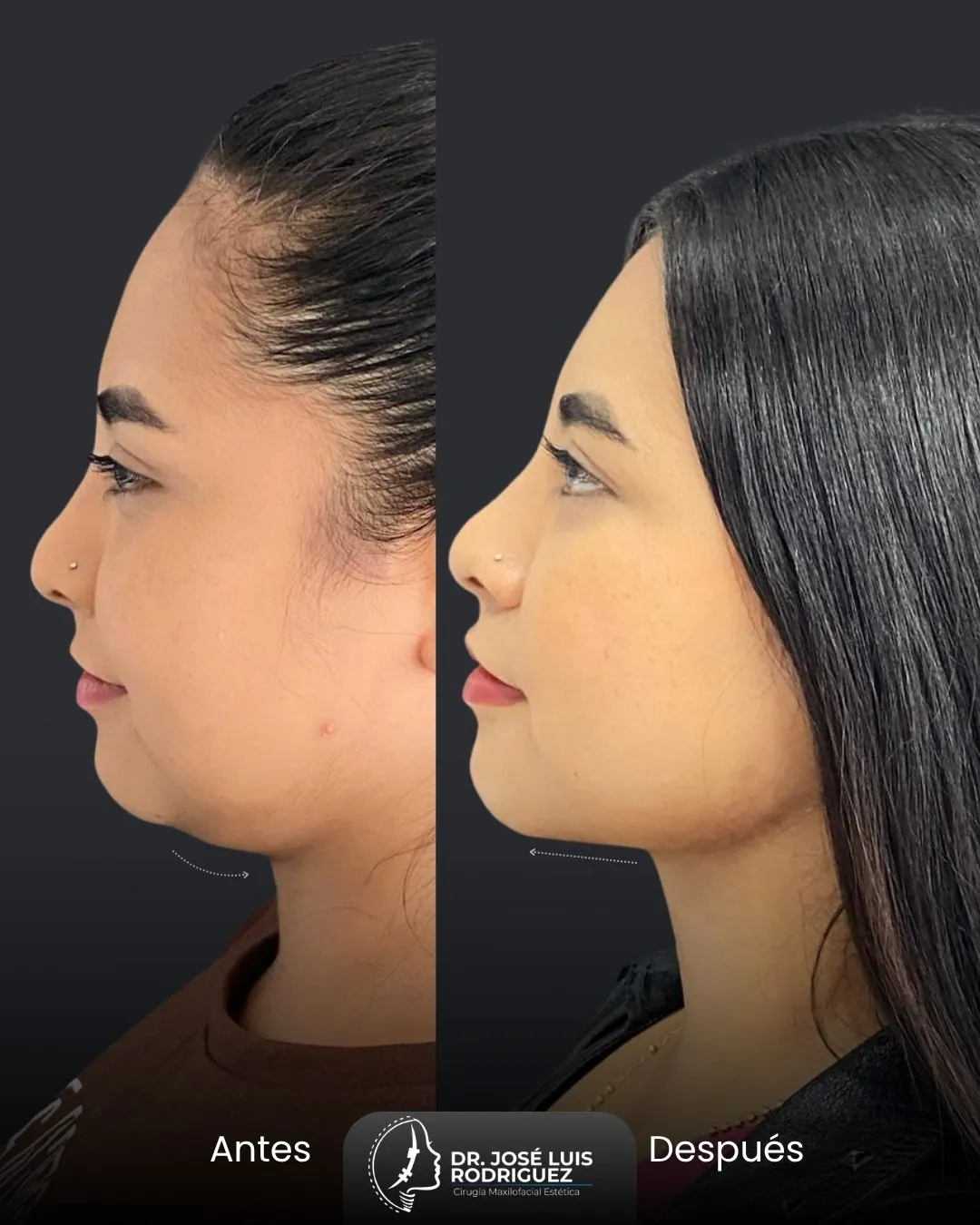 Resultado de platismoplastia - Dr. José Luis Rodríguez, cirujano maxilofacial en Colombia
