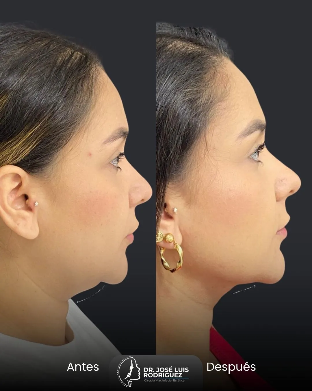 Resultado de platismoplastia - Dr. José Luis Rodríguez, cirujano maxilofacial en Colombia