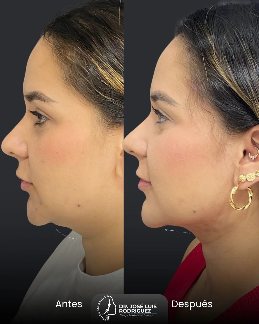 Resultado de platismoplastia - Dr. José Luis Rodríguez, cirujano maxilofacial en Colombia