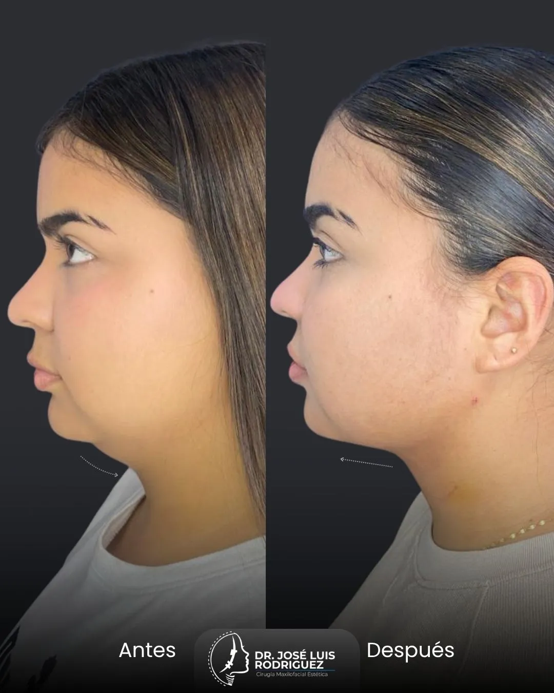 Resultado de platismoplastia - Dr. José Luis Rodríguez, cirujano maxilofacial en Colombia