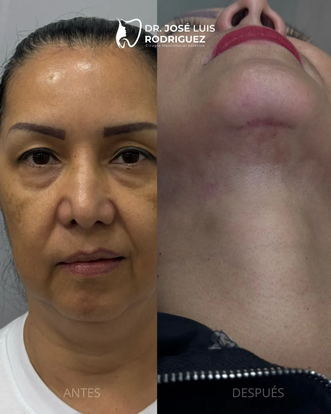 Resultado de platismoplastia - Dr. José Luis Rodríguez, cirujano maxilofacial en Colombia