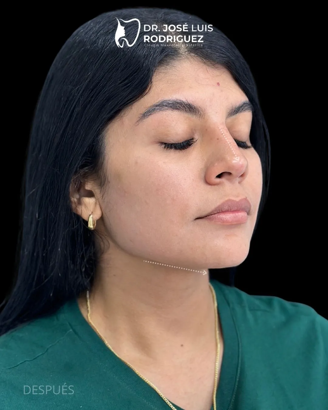 Resultado de platismoplastia - Dr. José Luis Rodríguez, cirujano maxilofacial en Colombia