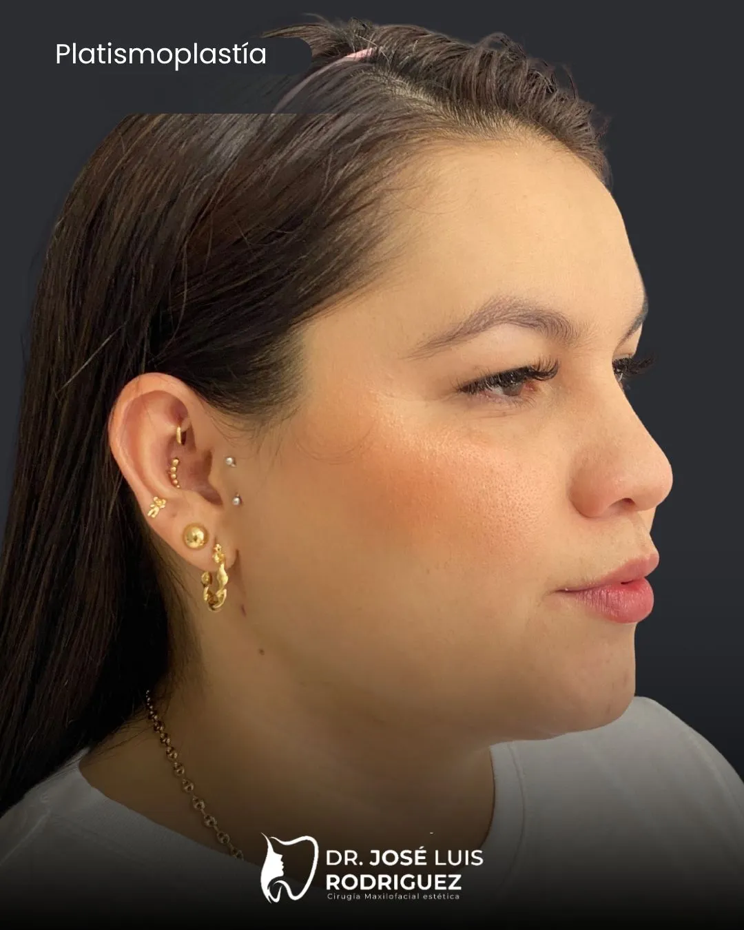 Resultado de platismoplastia - Dr. José Luis Rodríguez, cirujano maxilofacial en Colombia
